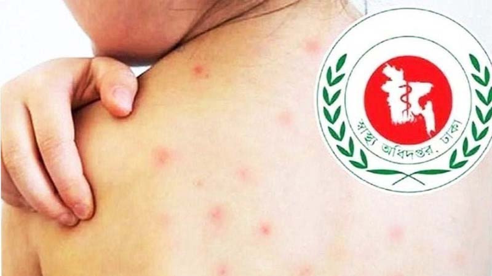 হামের  উপসর্গ নিয়ে আরও ৬ জনের মৃত্যু