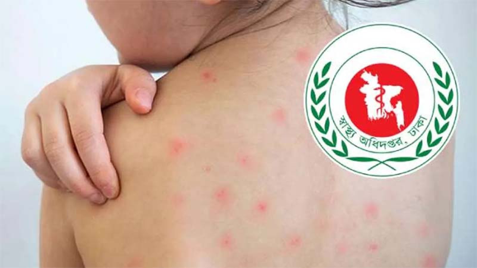 হাম উপসর্গে নিয়ে আরও আটজনের মৃত্যু