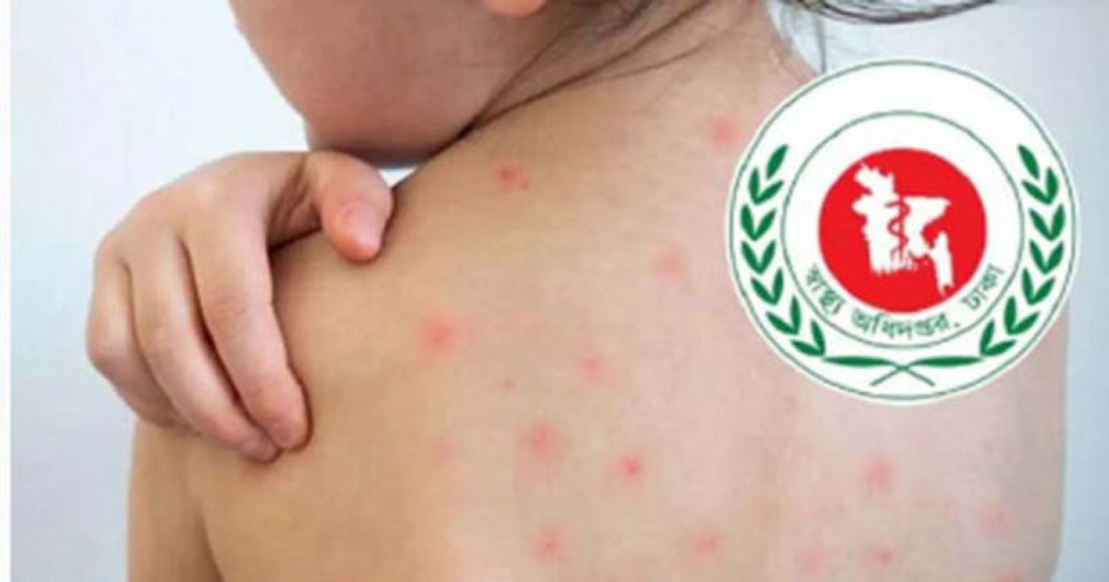 হাম ও হামে উপসর্গ নিয়ে আরও ৯ শিশুর মৃত্যু