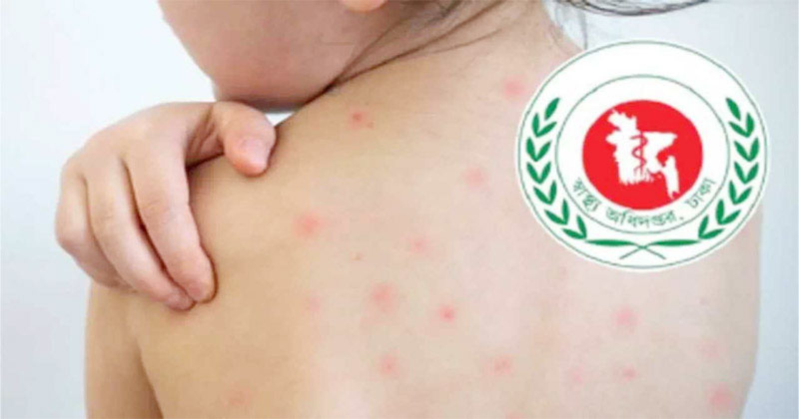 হামের উপসর্গ নিয়ে আরও ছয় শিশুর মৃত্যু